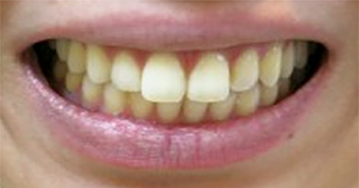 ボトックス注射 症例6