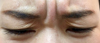 ボトックス注射 症例1