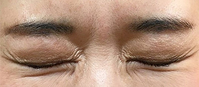 ボトックス注射 症例2