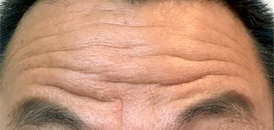 ボトックス注射 症例3