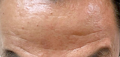 ボトックス注射 症例4