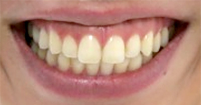 ボトックス注射 症例5