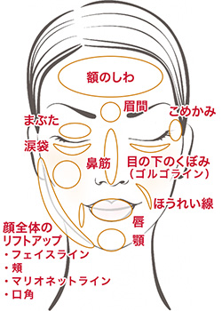 ヒアルロン酸の適応
