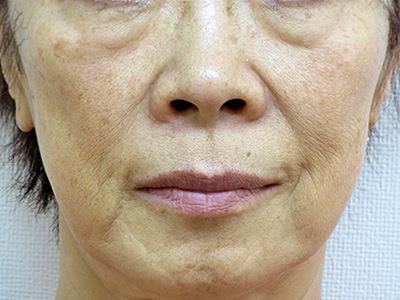 ヒアルロン酸 治療前