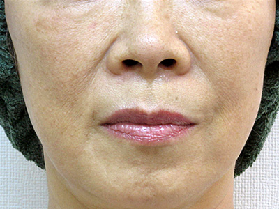 ヒアルロン酸 治療前