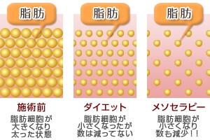 メソセラピー (ボディ)